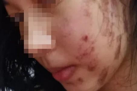 面部皮肤烫伤毁容图片,医院免费治疗毁容女孩