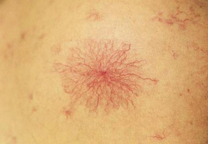 转氨酶超出正常值一倍,转氨酶超出正常值一倍什么原因