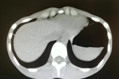 重度高碳酸血症突出表现,出现消化系统疾病的临床表现