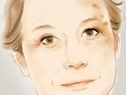 52岁脸上出现老年斑怎么办,47岁脸上有老年斑怎么治