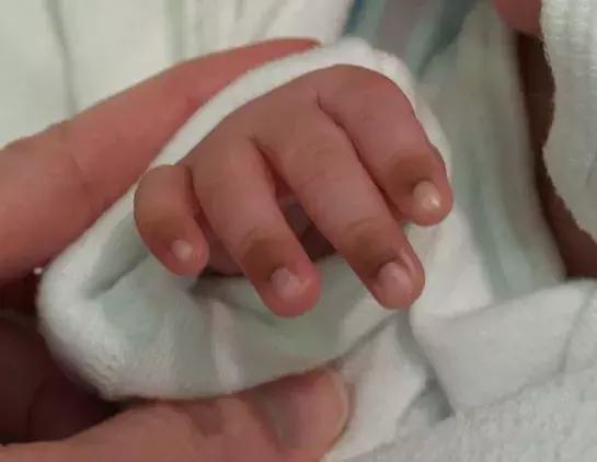 手指皮肤发黑是什么原因,手指关节处皮肤发黑发皱