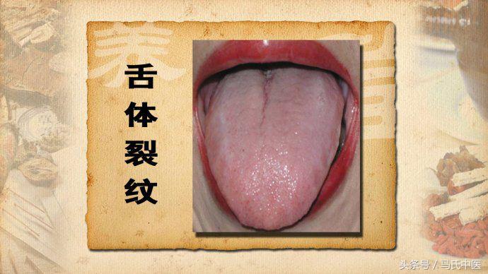 舌上裂纹是什么原因,舌中间横裂纹的中医辨证