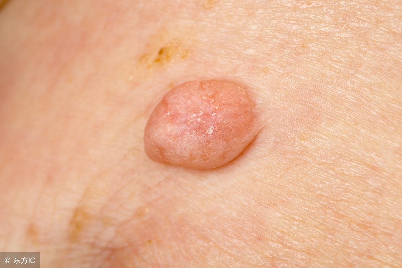 扁平疣怎么去除最快最有效,扁平疣如何去除