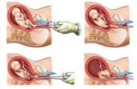 引产后的妇女相当于生了一次孩子，引产比正常分娩痛苦吗？