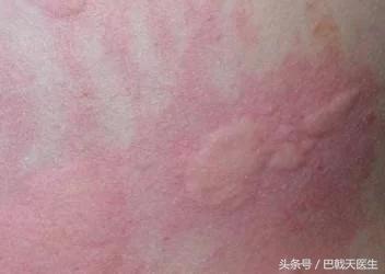 孩子出疹子宝妈需要忌口哪些,宝妈身上起疹子怎么办