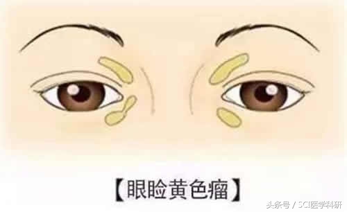 眼部血脂高的黄斑怎么去掉,眼部胆固醇怎么消除