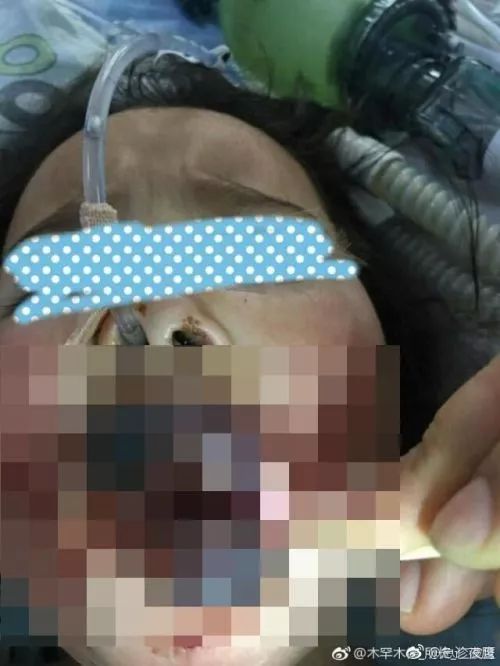 三度烧烫伤的症状是什么,儿童烫伤反复发冷发烧怎么办