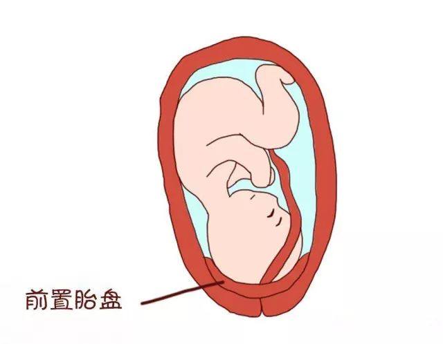 见红五天了还没动静什么原因,孕前期轻微见红是什么原因