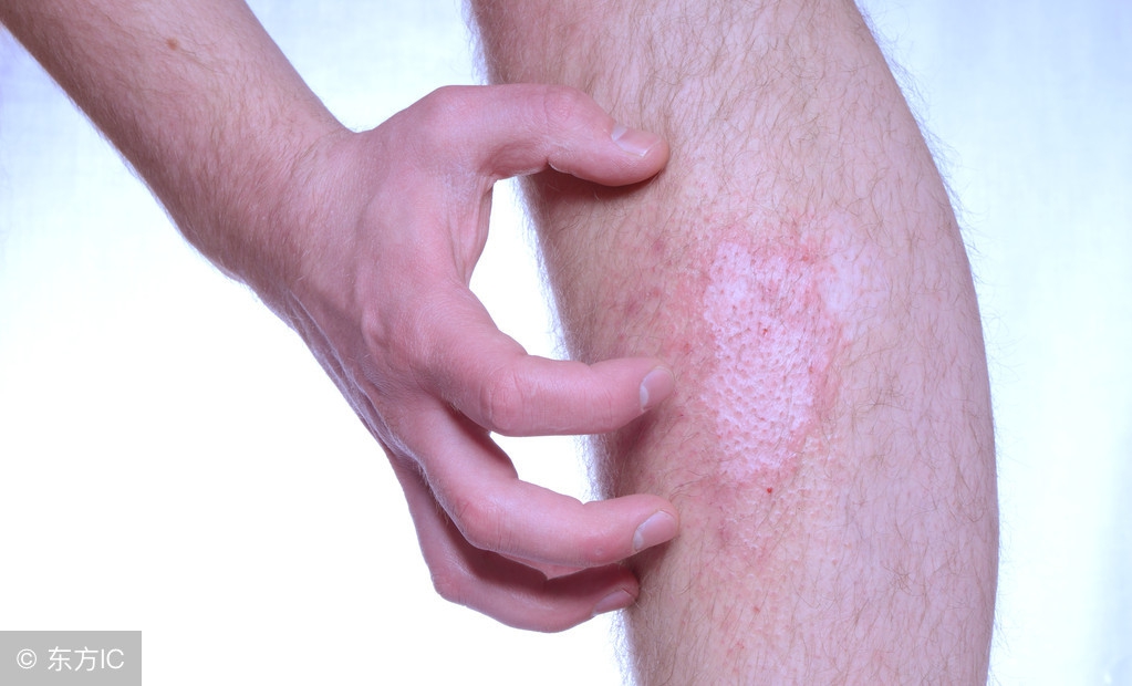 皮肤瘙痒越热越痒什么情况,冬天皮肤瘙痒越抓越痒怎么治