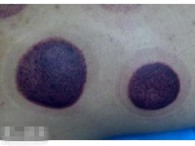 拔火罐印记颜色代表什么,拔火罐黑紫印是什么原理