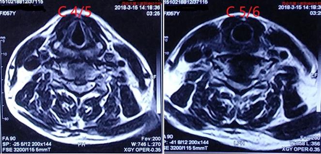神经根型颈椎病大夫让按摩推拿,祖传神经根型颈椎病正骨复位手法