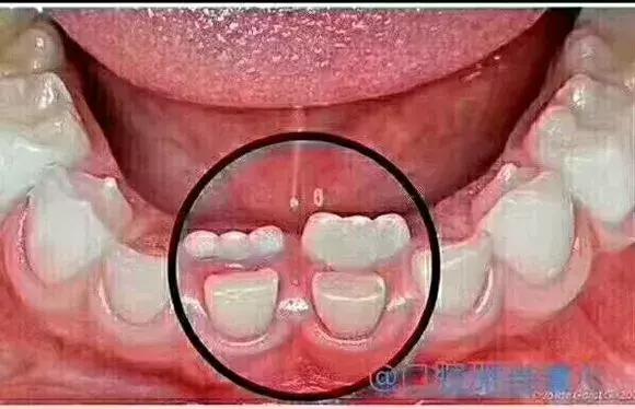 双排牙预防方法,预防孩子双排牙有什么方法