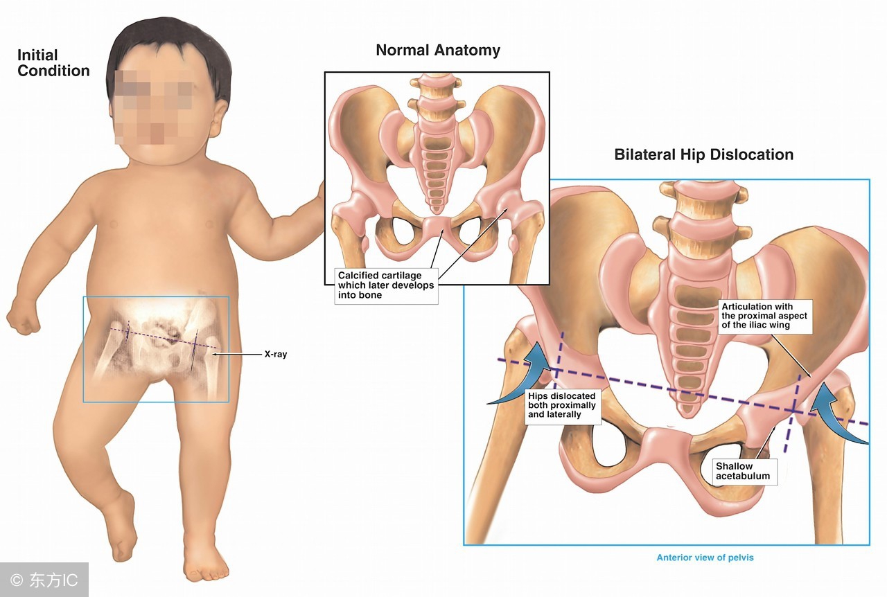 2岁宝宝髋关节不对称走路不稳,宝宝3岁了走路不稳是怎么回事