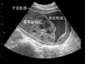 孕初期宫腔积血是什么原因引起的,怀孕9周宫腔积血先兆流产严重吗