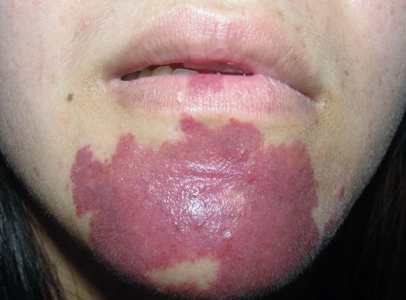 面部鲜红斑痣对求职影响,红胎记和鲜红斑痣能消失吗