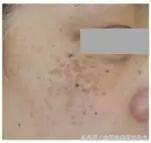 褐青斑和褐青色痣有什么区别,褐斑和褐青色痣区别