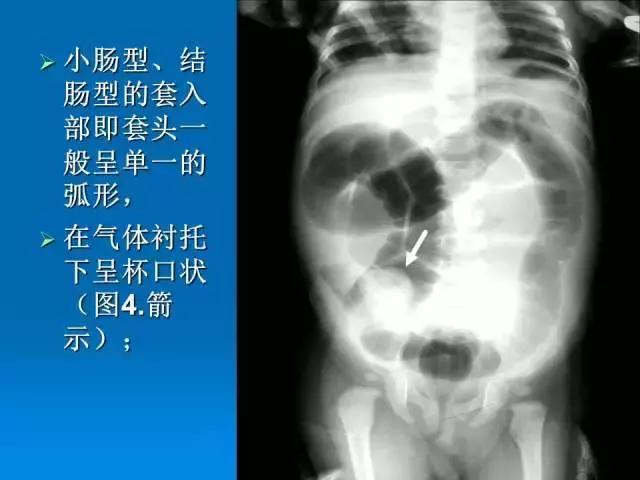 小儿肠套叠空气灌肠需要注意事项,儿童肠套叠空气灌肠要不要住院