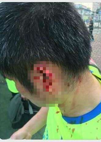 泰森咬耳朵事件咬掉了吗,泰森拳击比赛咬耳朵这一场谁赢了