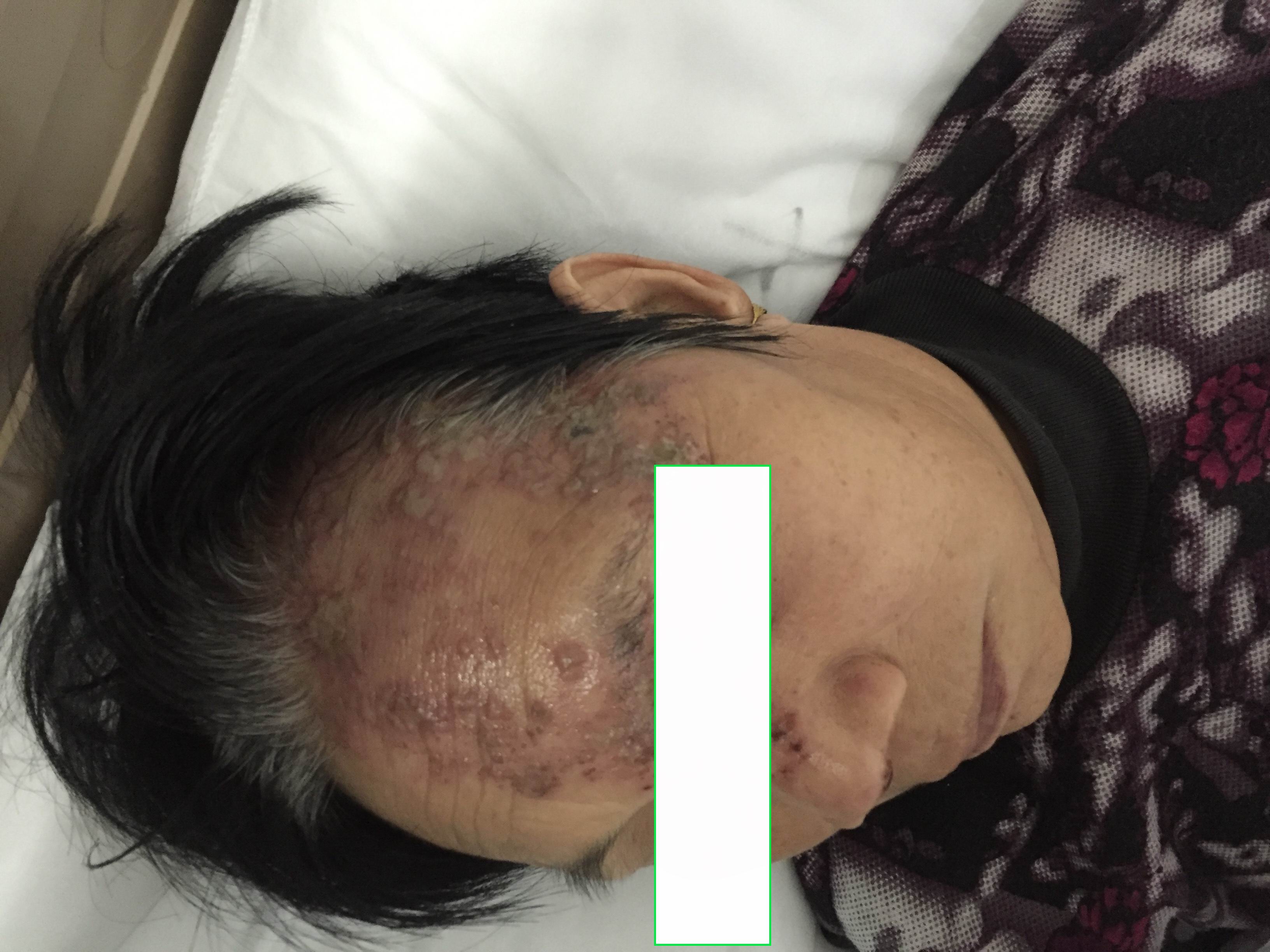 带状疱疹眼睛疼多久能好,眼带状疱疹对眼睛的影响