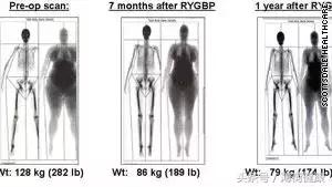 女性大腿内侧肉松弛怎么锻炼,腰和左大腿内侧肉疼什么原因