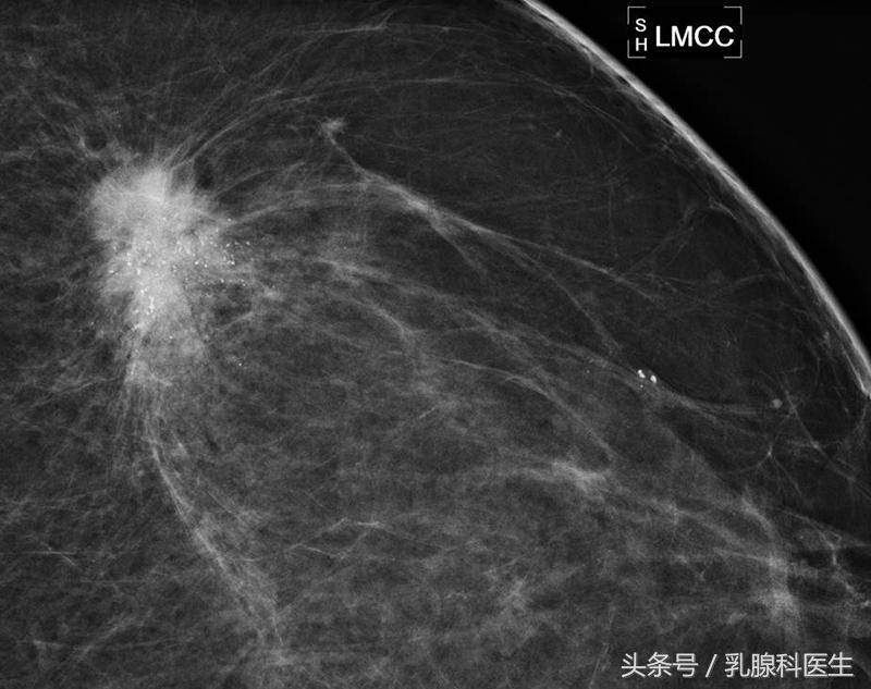 乳腺肿物切除术多久恢复,孕期乳腺肿块是怎么回事