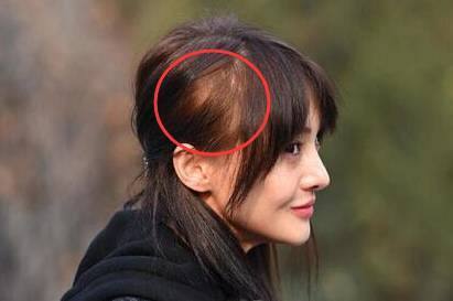 头发太少影响颜值了怎么办,细软头发如何防脱发