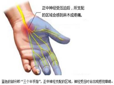 每天握鼠标手疼怎么办呢,鼠标手小臂酸痛怎么缓解