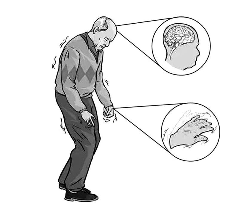 帕金森综合症是神经出问题吗,帕金森综合征是什么