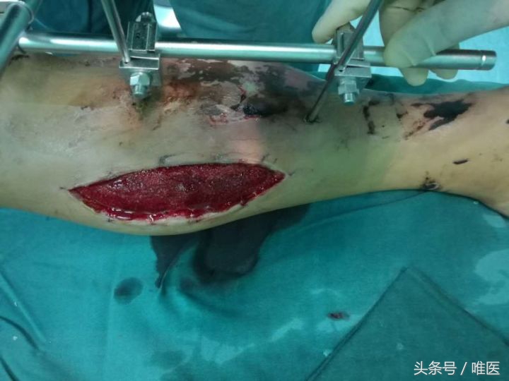 缓解截肢后疼痛的办法,截肢后的幻肢痛怎么解决日常生活