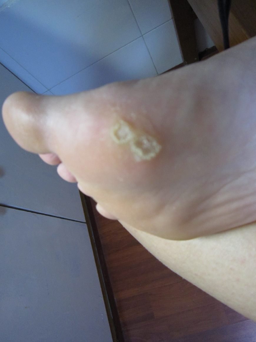 长期光脚走路会不会使脚下长老茧,脚下为什么长老茧