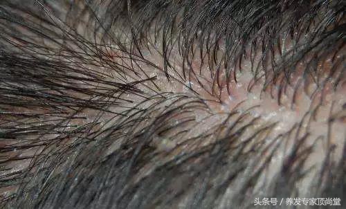 顽固性头屑头痒怎么治,头痒头屑头油多怎么办