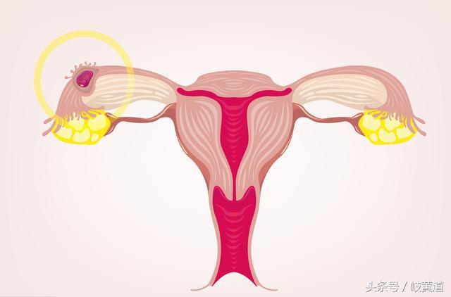 停经子宫出血是怎么回事,停经后阴道出血是什么症状