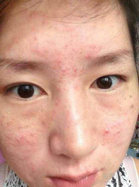 脸上长痘粉刺什么原因,脸上长粉刺是肝不好吗