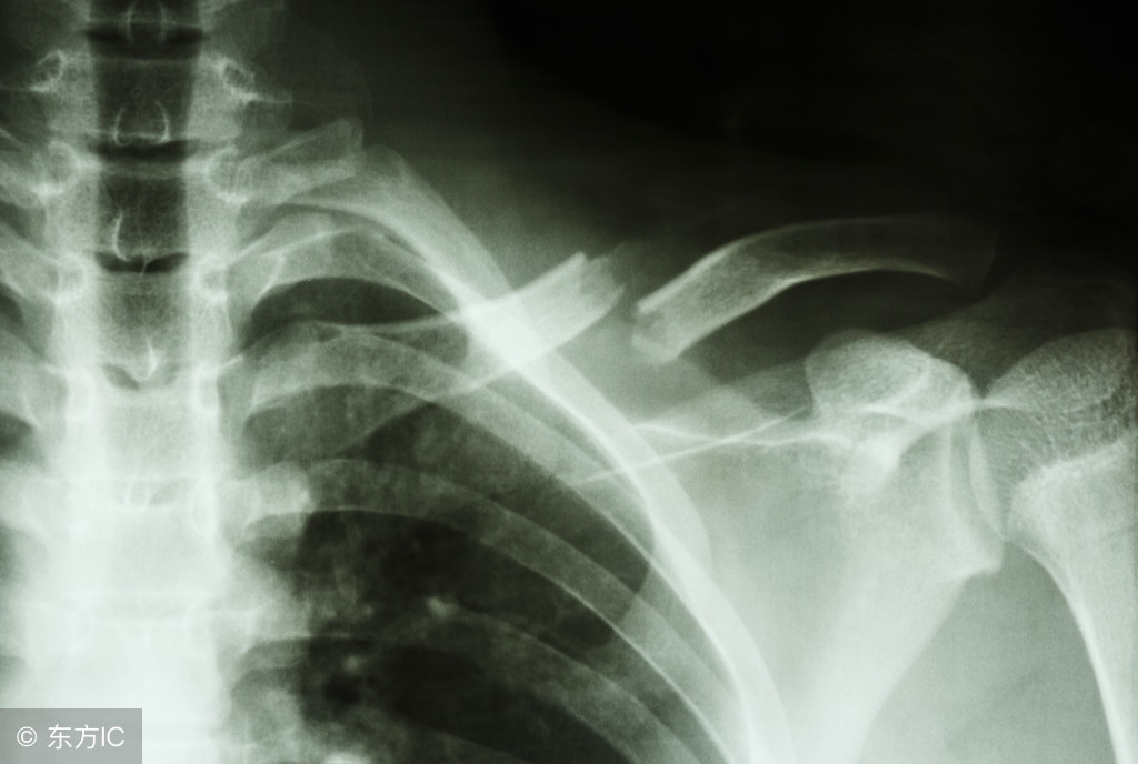 胸骨陈旧性骨折怎么治疗,胸骨骨折断端错位的怎么治疗