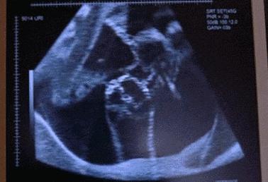 这两天胎动强烈怎么回事,胎动两边拳打脚踢