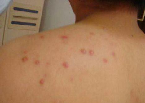 后背长了一个螨虫大疙瘩怎么去除,两天不洗澡就后背长痘痘是螨虫吗