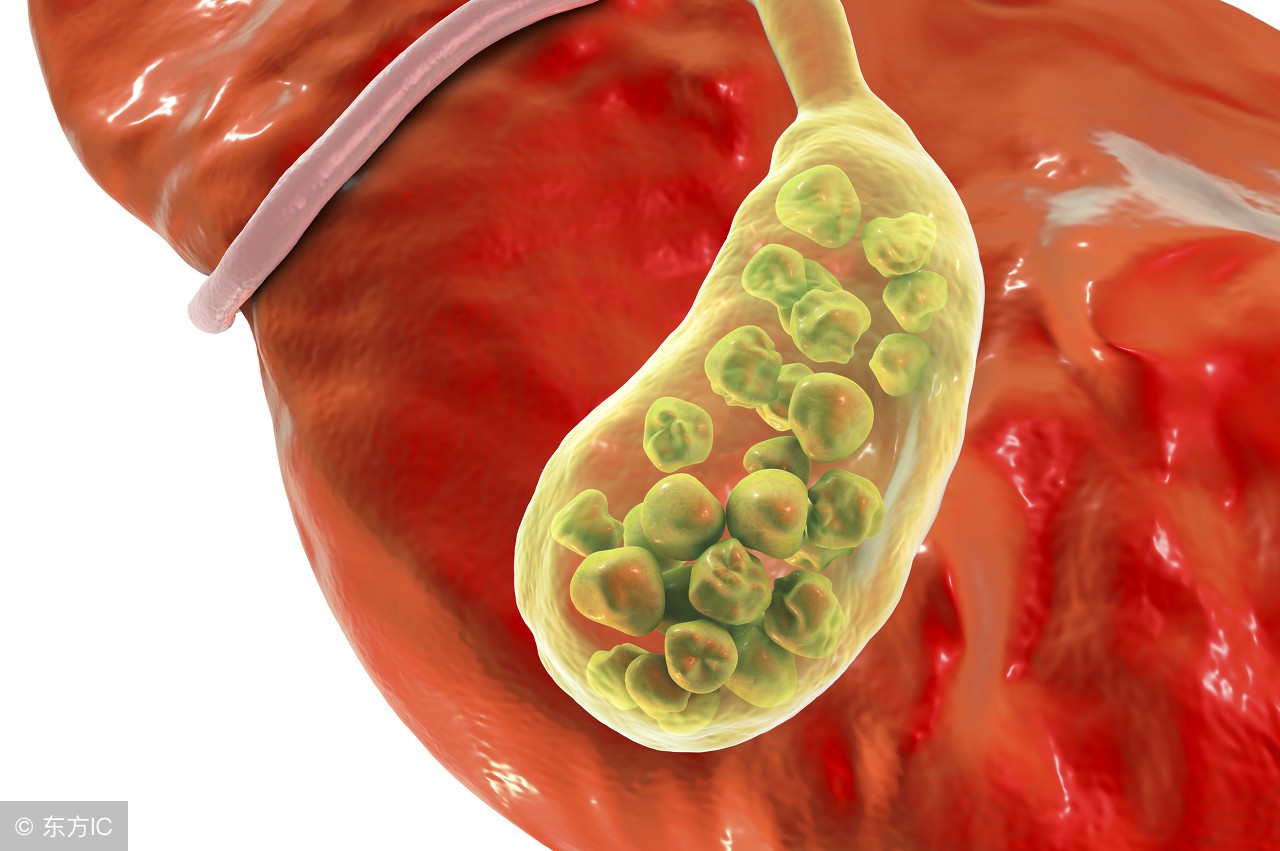 胆结石的联合用药治疗,胆结石的食疗方法哪种有效
