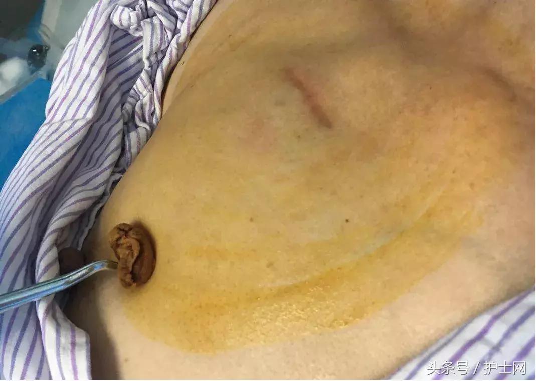 输液港扎针最全示范,输液港拔针的正确方法视频教程