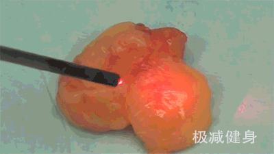 抽脂减肥的过程与效果,抽脂减肥的过程和效果