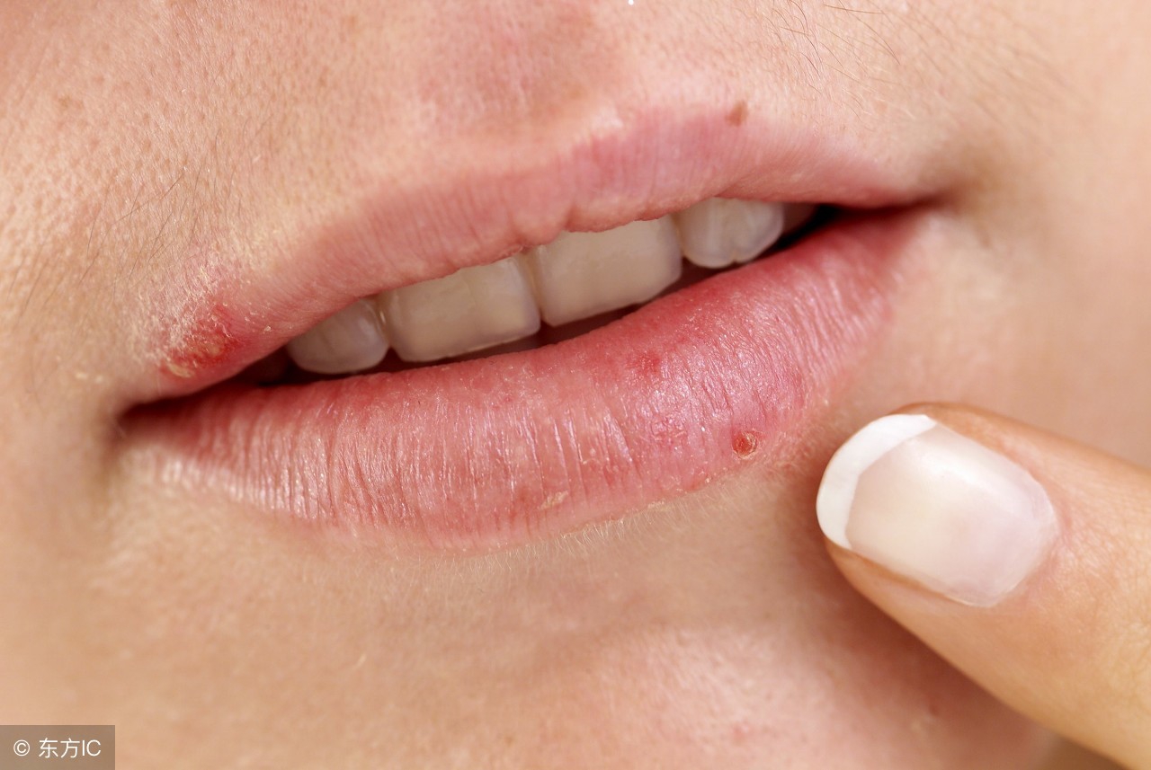 嘴唇上火起痘怎么快速消除,嘴唇周围上火起痘是什么原因
