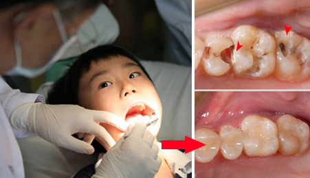 儿童乳牙蛀牙洞里长肉怎么办,乳牙蛀牙只剩根部需要拔掉吗