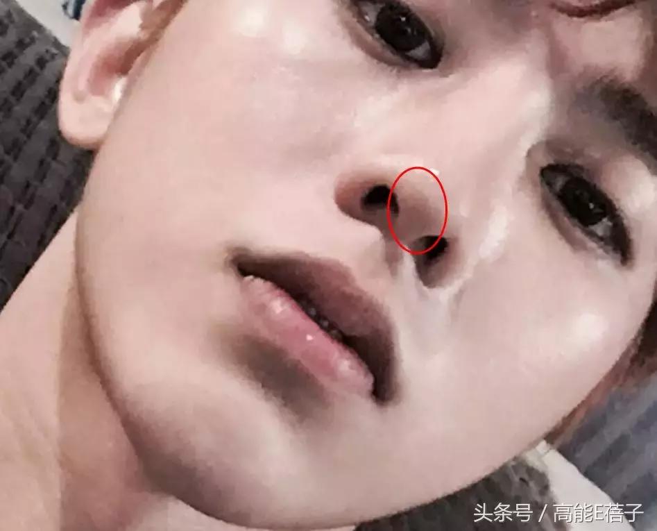 别傻了！蔡徐坤、Angelababy都根治不掉的黑头，微商神器能去除？