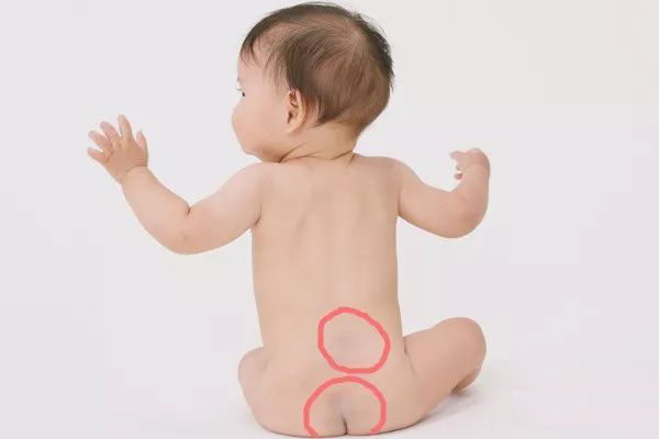 婴儿出生时屁股上发青咋回事,宝宝屁股后背发青什么时候会消失