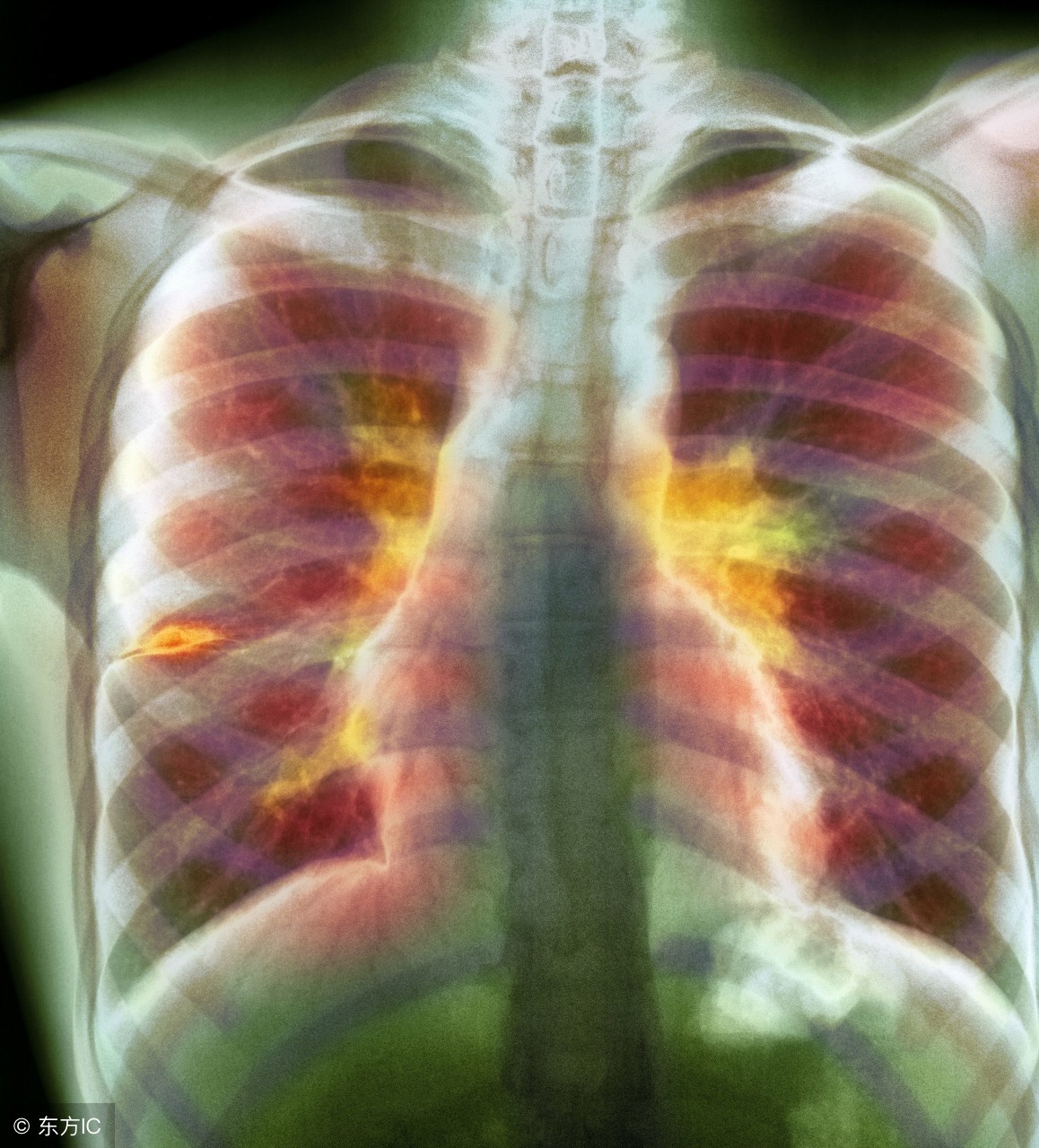 肺结核膳食指导手册图片,肺结核合并糖尿病病人的营养膳食