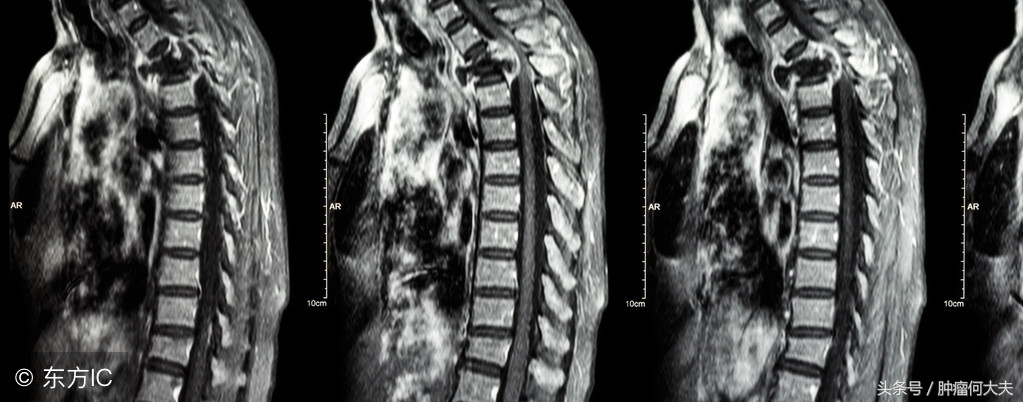 骨转移癌如何形成？治疗方法是什么？预后如何？