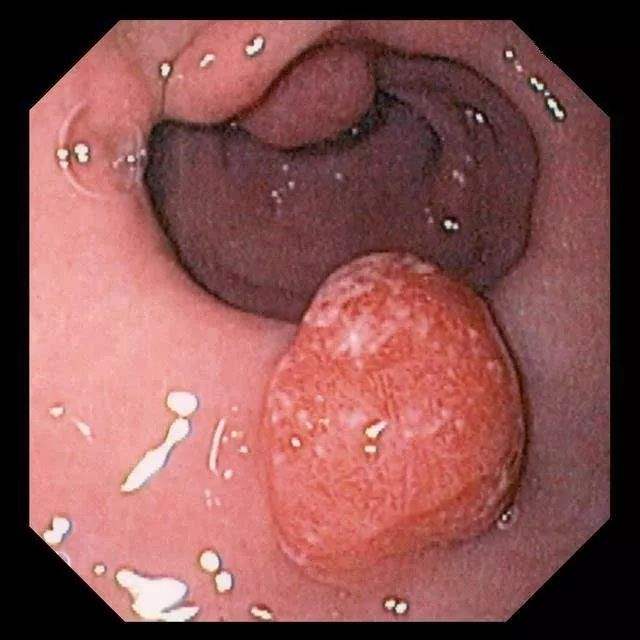 胃肠息肉手术多少钱,胃肠息肉的症状表现