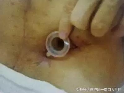 造口护理小窍门视频,更换造口护理技术操作流程