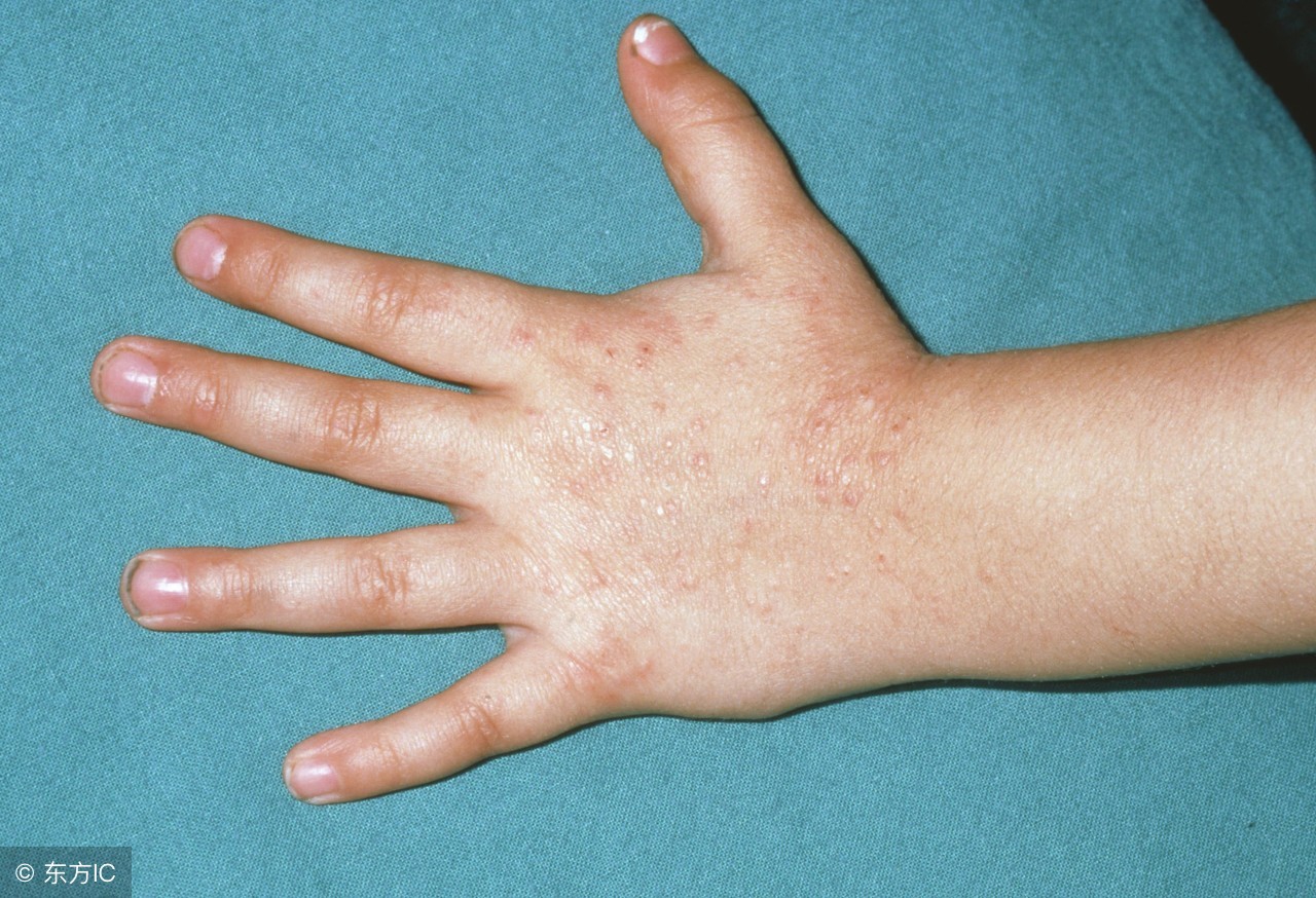 因湿疹而引起的皮肤瘙痒如何处理,湿疹反复发作奇痒中医给两种方法