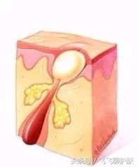 只有长痘才知道痘痘有多难治,要知道痘痘的根源