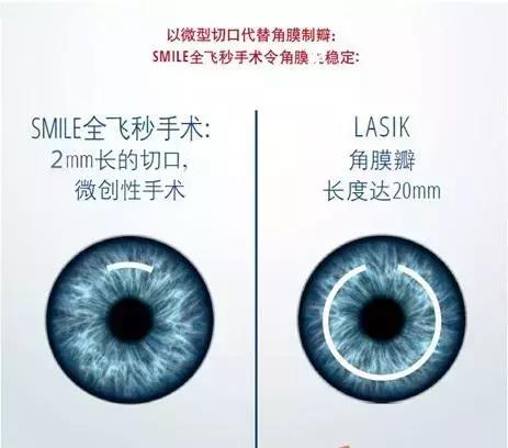 全飞秒和半飞秒治近视可重复做吗,全飞秒与半飞秒的治疗效果